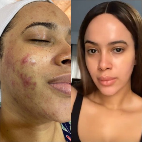 Acne scars