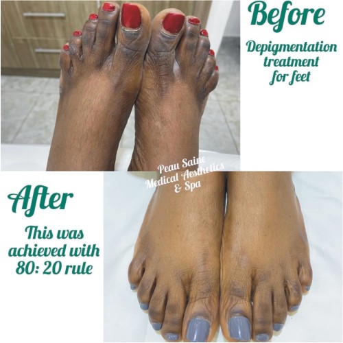 Feet Dark knuckles treatment
