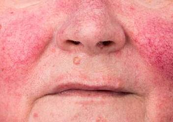 Rosacea