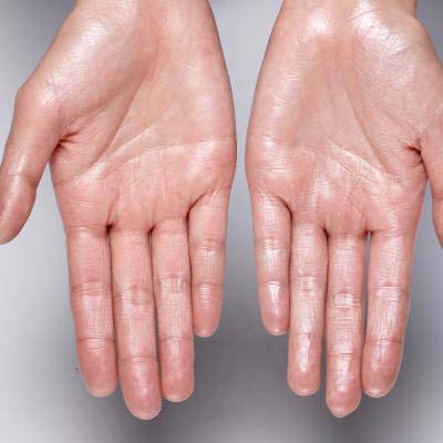 Hyperhidrosis Treatment