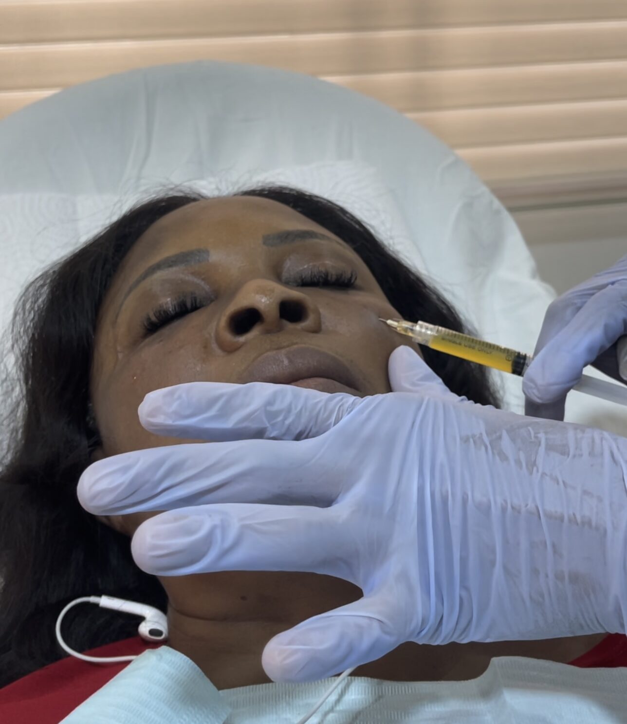 Vampire facial / Microneedling