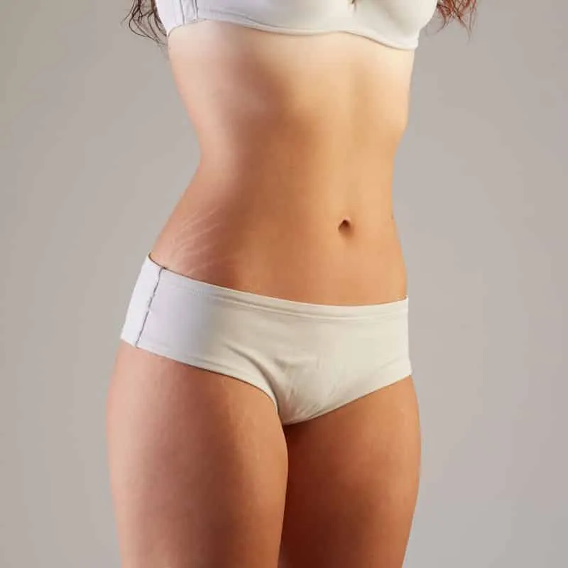 Stretch Mark Treatments